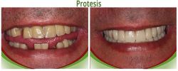 Protesis 02
